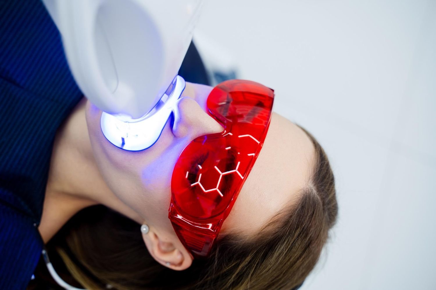 Teeth Whitening